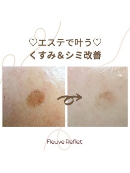 フルーヴ ルフレ(Fleuve Reflet)/夏でも受けたいシミケア☆