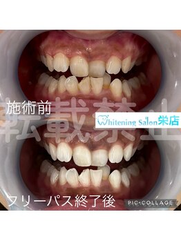 ホワイトニングサロン 名古屋 栄店/【ホワイトニング】