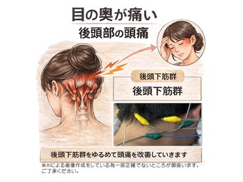 たけ鍼灸院 新所沢/後頭部の頭痛・眼精疲労に