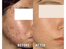 アクネ菌ケア専門サロン ベネーブ 武蔵小杉店/アクネ菌ケア