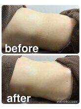 ギンザアール(GINZA R.)/ぽっこりお腹にアプローチ！！