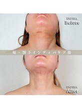 術後の女神 大阪心斎橋店/術後ケアインディバ・インディバ