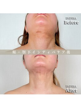 術後の女神 大阪心斎橋店/術後ケアインディバ・インディバ