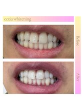 エクシアホワイトニング 東上野店/ホワイトニングビフォーアフター