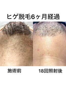 イエナ(IENA)/デザイン残しも可能なヒゲ脱毛