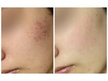 ハーブピーリング剥離あり/月1/2回施術