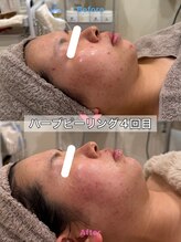 ルポアン(Repos an)/ハーブピーリング　before after