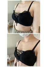 サロン ド チョコ(SALON DU CHOCO)/【バストアップ】症例