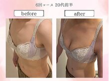 リール 恵比寿店(RIRE)/バストアップ症例【広尾恵比寿】