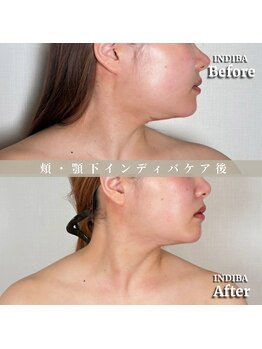 術後の女神 大阪心斎橋店/術後ケアインディバ・インディバ