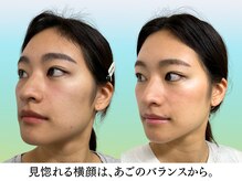 ナチュラルビューティーフェイス 横浜(NBF)/Before&After