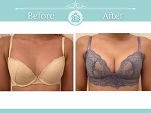 美人バスト 表参道店/【バストアップ/育乳 症例】