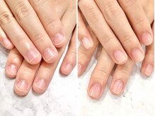 リファーレ(RIFARE)/【深爪矯正】Before→After