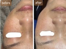 ルビー(Ruby)/【50代】ハーブピーリング2回