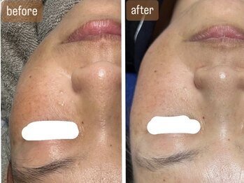 ルビー(Ruby)/【50代】ハーブピーリング2回