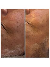 ディープブルー(Deep Blue)/プラペンデュアル施術