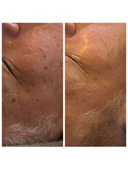 ディープブルー(Deep Blue)/プラペンデュアル施術