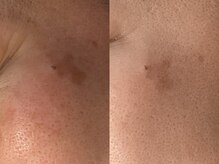 サロンソワ(salon Soi.)の雰囲気(天然ハーブで古い角質を整え、毛穴・くすみをケア!一度で実感◎)