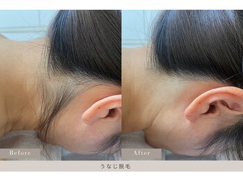 ミランジュ 新瑞橋(miranju)/うなじ脱毛BeforeAfter
