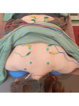 鍼呼灸 森の音/鍼灸施術のイメージです