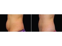 ソルツーサロン マナ(MANA)/お腹・腰回りの出張りもスッキリ