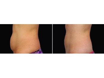 ソルツーサロン マナ(MANA)/お腹・腰回りの出張りもスッキリ