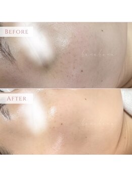 ハナハナ(hanahana)/コンシーラー卒業!