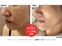 トリアングル(TLIENGLE)/最新ポレーションビフォアフ