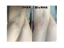 プリマプリート メンズ店/ワキ脱毛する方、増えてます！