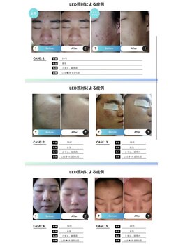 プラスベル(plus Belle)/もう皮膚科に行かなくていい