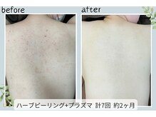 ウェルビー(Well-Be)の雰囲気（【ハーブピーリング】男女◎ニキビケア、毛穴黒ずみザラつき改善）