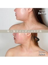 術後の女神 大阪心斎橋店/術後ケアインディバ・インディバ