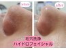  毛穴ケア人気No.1ハイドロフェイシャル/水素水毛穴洗浄吸引＋美肌パック  
