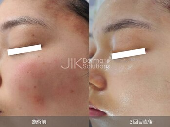 レディラックビューティー 横浜(Lady Luck beauty)/肌荒れによる赤ら顔に★