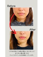 ダイエット×オーダーメイド整体/ほうれい線撃退でエイジングケア