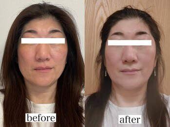 アリス(ALICE)/小顔矯正1回目