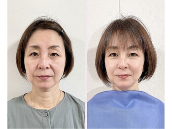 エピファニー 東京 銀座/ビフォーアフター(N様 50代)