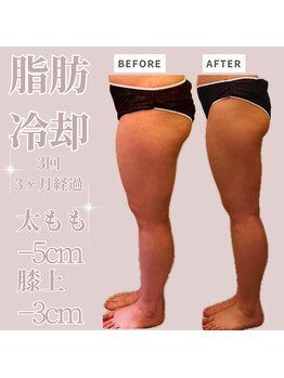 アイビー(IVY)/全身脂肪冷却モニター様