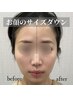 【速攻小顔】超音波リフト/脂肪を減らし筋膜にアプローチ小顔造形 ¥11,000