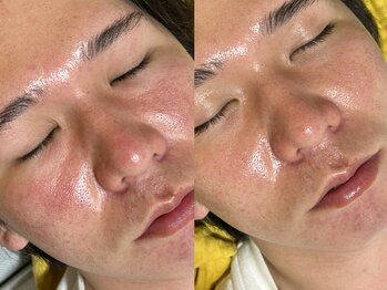 クラウン 心斎橋店(CROWN)/眉毛/脱毛/シェービング/小顔/