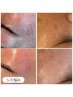 【人気NO.1】シミケア*最新のプラズマケアで徹底改善*透明肌へ　