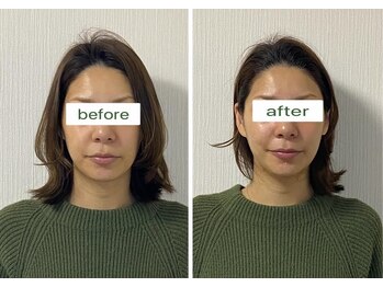 アプロディタ/お顔の筋トレで小顔効果