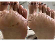 ロンディネ(Rondine)/韓国式足裏角質ケア