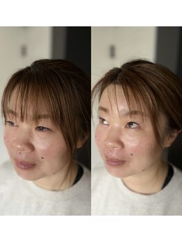 アコ(AKO)/リフトアップ☆EMS & WAX