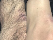 エステティック 華/爆抜け！短期間で効果実感