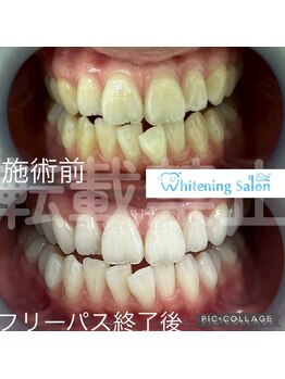 ホワイトニングサロン 名古屋 栄店/【ホワイトニング】