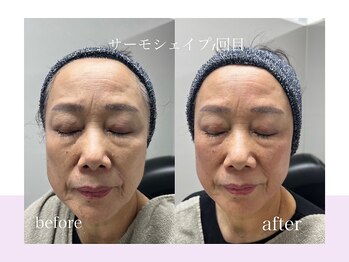 スキンラボ ドットシキブ 厚木海老名店(skinlabo .sikibu)/ビフォーアフター3