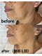 エヌ サロン(enu salon)の写真/【たるみに特化した新マシン導入】７月導入記念でお得なフェイシャルメニュー！