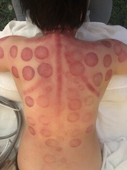 中国整体 らくらく堂/温熱療法経絡吸い玉デトックス