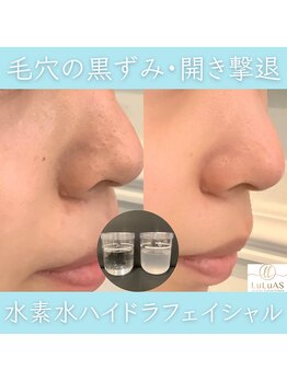 ルルアス 銀座(LuLuAS)/イチゴ鼻|毛穴開き|黒ずみ|角栓